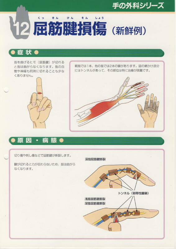 手根管症候群 Chirurgia Della Mano Dr Loris Pegoli